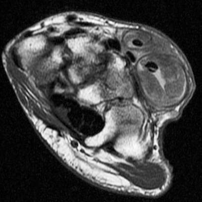 Figure 3 for case Rheumatoid arthritis ( RID3561 )